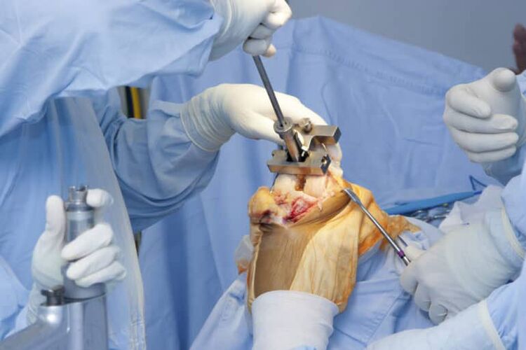 knee arthrosis surgery