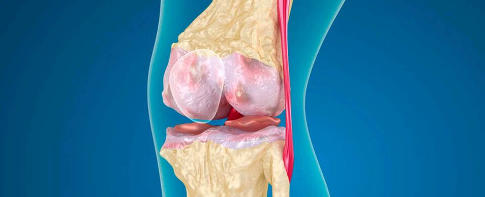 arthrosis of the knee joint as a cause of pain