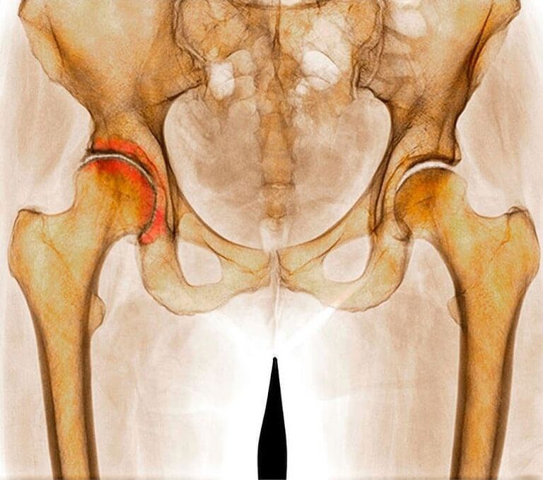 inflammation of the hip joint as a cause of pain
