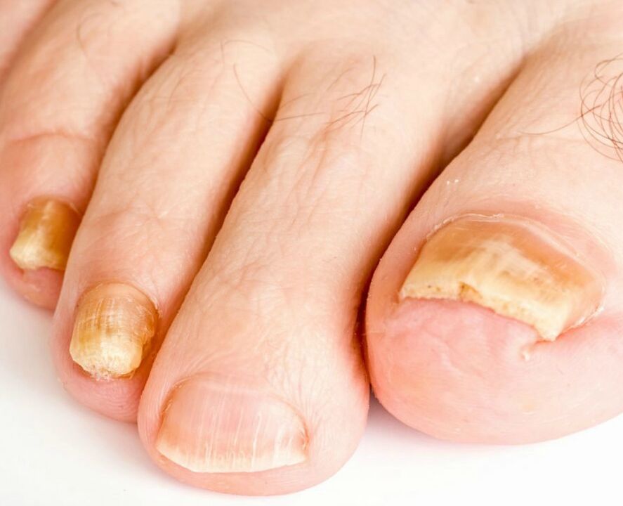 fungus on the nails