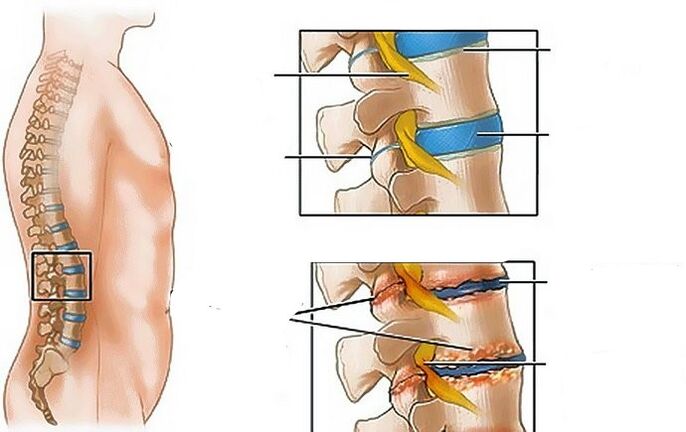 Osteochondrosis of the lumbar region