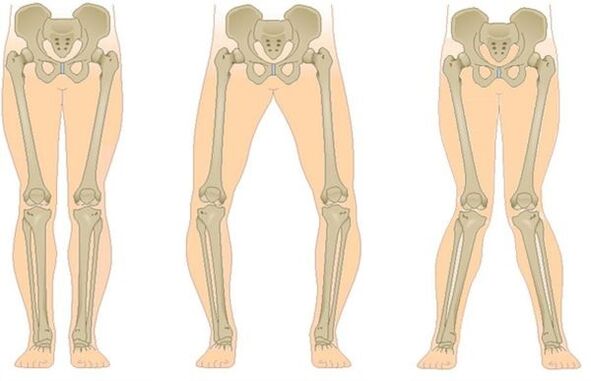 types of arthrosis