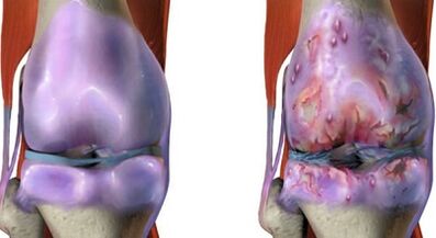 The main differences of arthritis and arthrosis