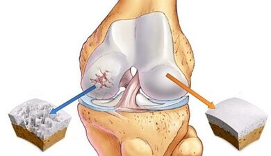 The reasons for the development of arthrosis of the joints